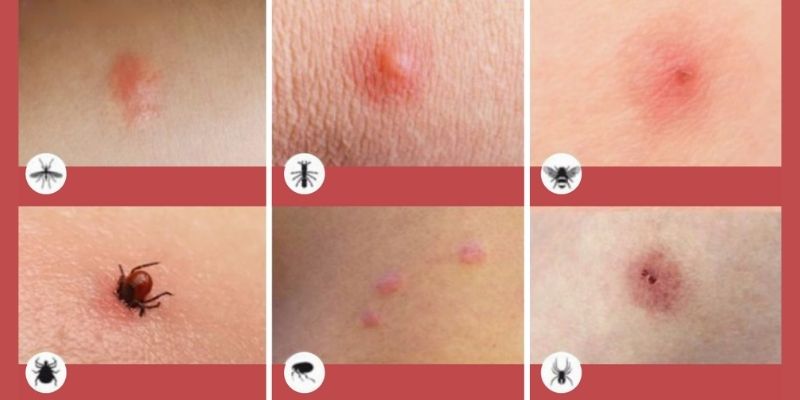 ВАЖНО! 8 типов укусов насекомых, о которых вы просто обязаны знать!